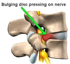 Do You Have a Herniated Disc?
