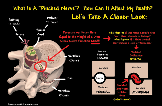 End Pinched Nerve Suffering Without Surgery