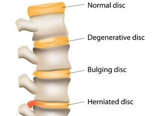Disc disease McQuaite Chiropractic