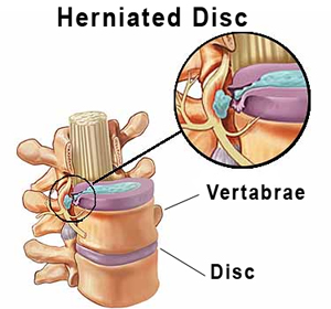 Herniated Disc: Definition, Symptoms and Causes