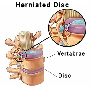 Slipped Disc Symptoms, Causes and Treatment