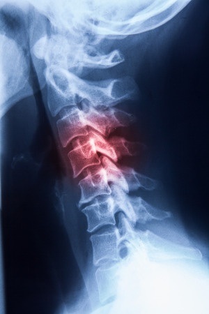 Help for Back Pain after an Accident