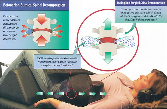 Spinal Decompression Spinal Decompression